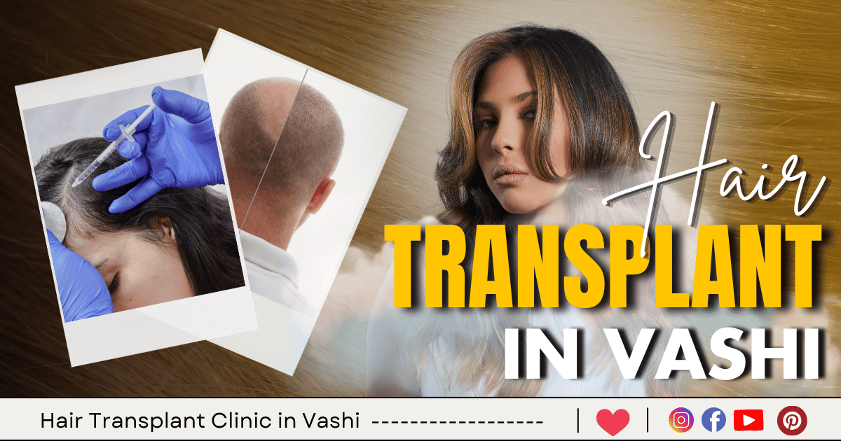 3 Best Hair Transplant Clinic in Vashi – Navi Mumbai
